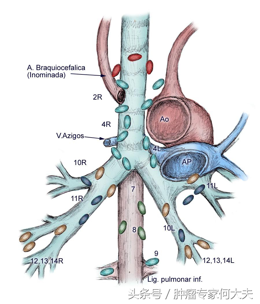 肺癌晚期临死30天症状,肺癌小细胞晚期快死的征兆