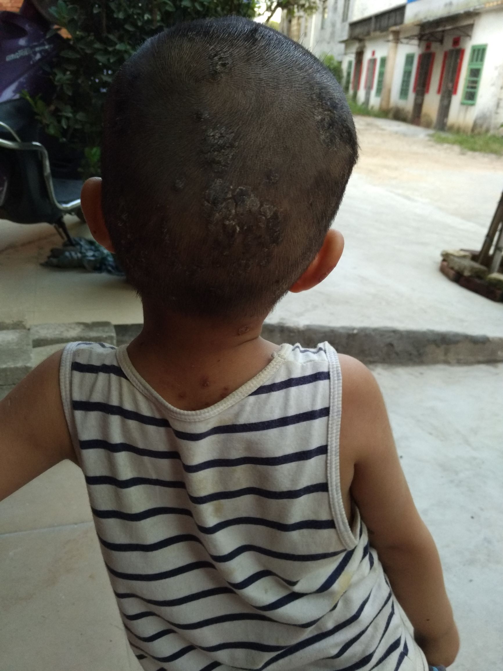 孩子在幼儿园被传染上虱子怎么办,小孩被传染疮了怎么办