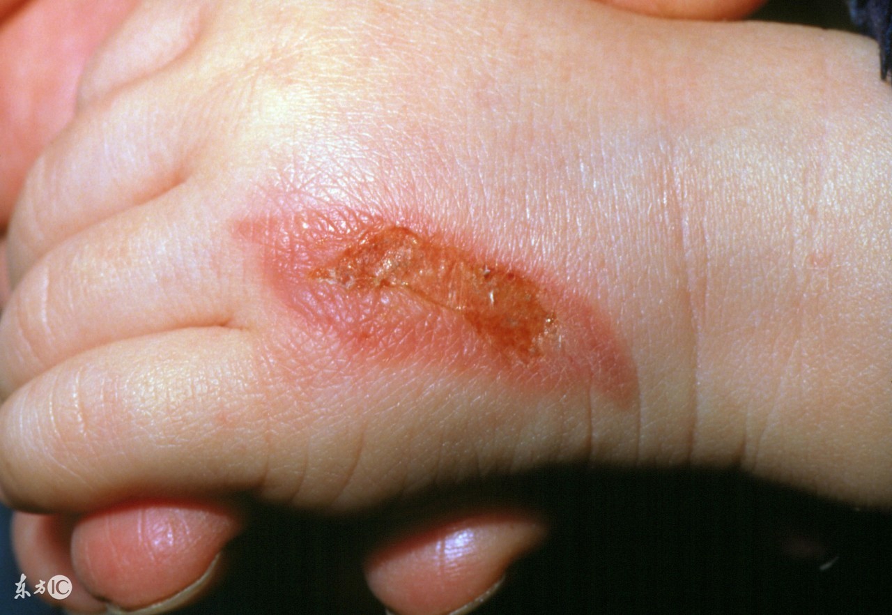 揪心小孩烫伤,孩子被烫伤后父母揪心的痛