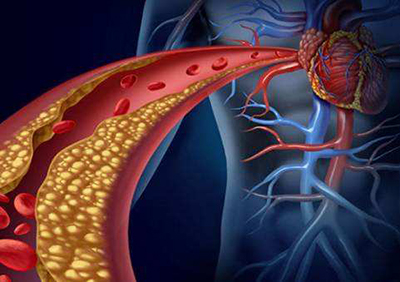 腔隙性脑梗塞能做血液净化吗,预防腔隙性脑梗死