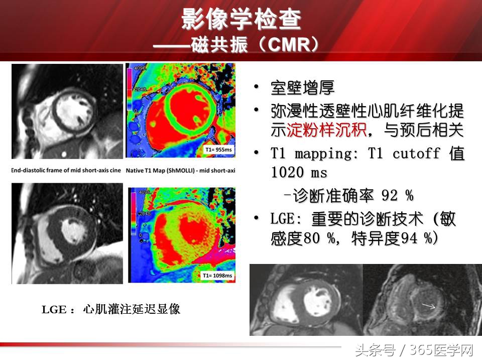 心力衰竭心房颤动,心衰时心肌酶的变化