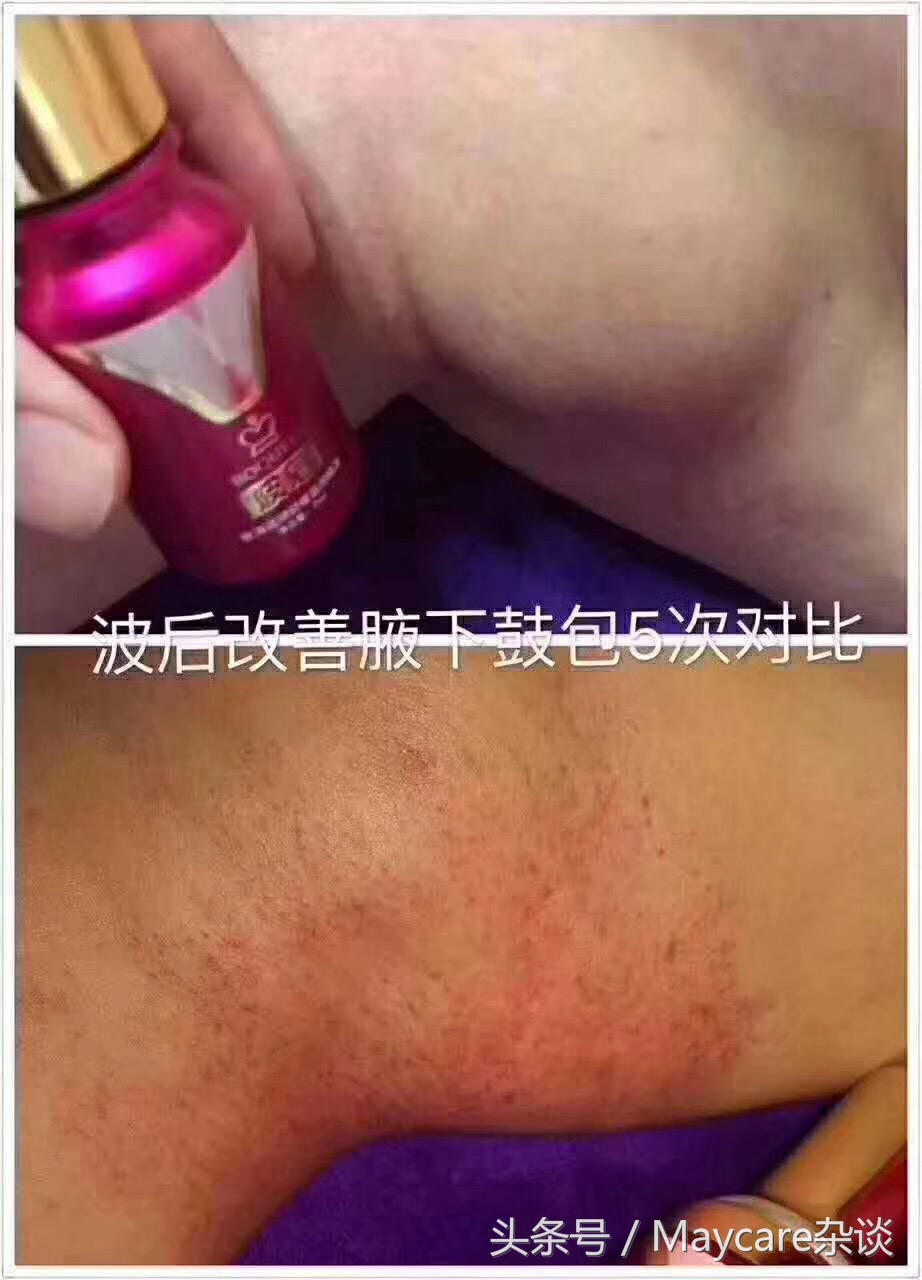 副乳腋下淋巴结堵塞,腋下淋巴结肿大活检危害