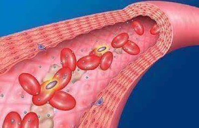 弱激光体外血液净化预防血栓，改善肺栓塞等严重情况