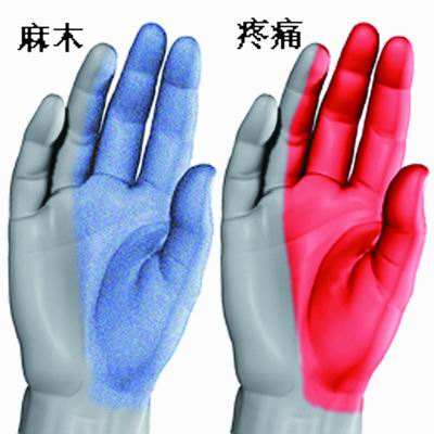 晨起手指麻木是什么原因和征兆,晨起手肿胀要警惕四种病