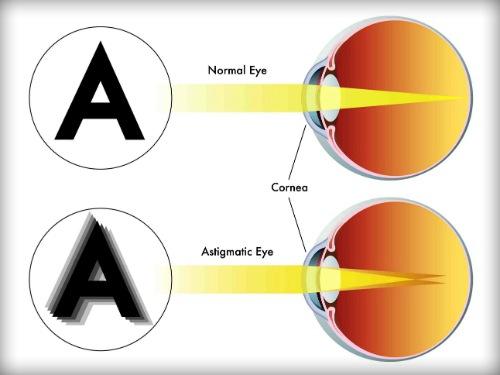 散光75度怎么样缓解,关于镜片你不得不知道的几点知识