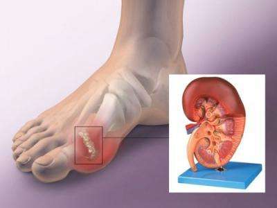 痛风居然还会引发尿毒症？医生告诉你三种方法治疗痛风！