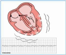 心脏起搏器引起呼吸困难处理,心脏起搏器怎么停止