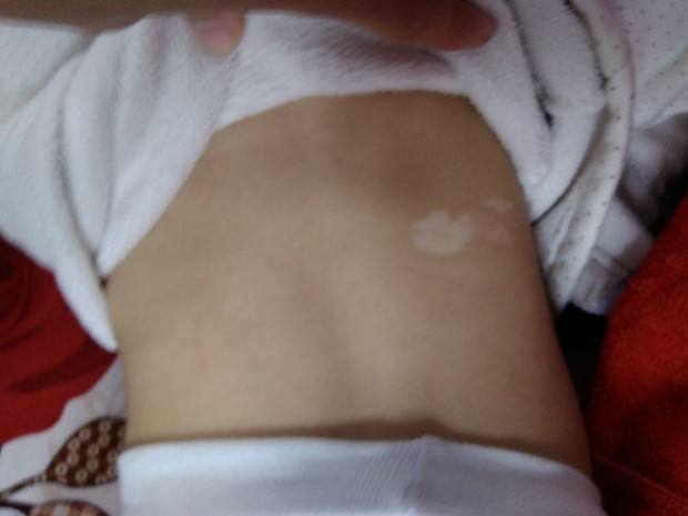 两岁小孩出现白斑怎么回事,两岁小孩脸上有一小块白斑