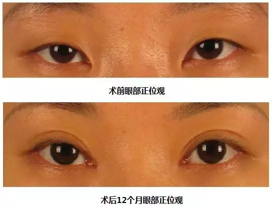 眼科大夫做双眼皮,想做双眼皮医生建议