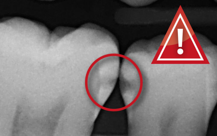 为什么两颗牙不能同时治疗,哪一颗牙最不容易发生蛀牙