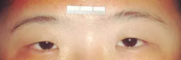 眼科大夫做双眼皮,想做双眼皮医生建议