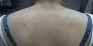 背后长很多小米粒该怎么办,背后长了很多的小米粒用什么药