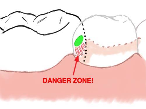 为什么两颗牙不能同时治疗,哪一颗牙最不容易发生蛀牙