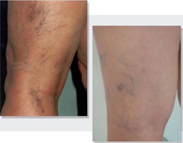 下肢静脉曲张的症状及治疗方法,下肢静脉轻度曲张穿几级弹力袜