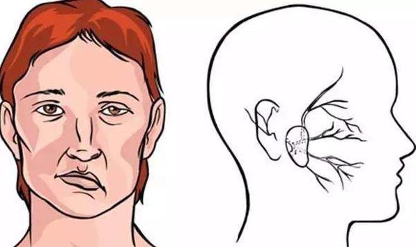 中风面瘫嘴歪了快速治疗方法,面瘫高压氧舱治疗有效吗