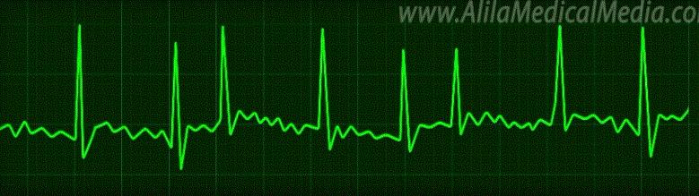 做房颤射频消融手术前的关注事项,房颤射频消融术后如何康复