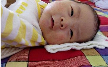 宝宝湿疹拉肚子怎么办,纯母乳宝宝湿疹加腹泻怎么回事