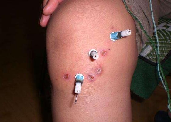 中医治疗骨刺特效方,治老年骨刺有效的膏药