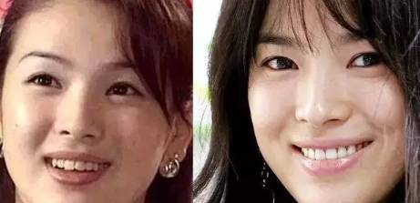 网上买透明牙套矫正牙齿靠谱吗,小孩矫正牙齿用哪种牙套比较好