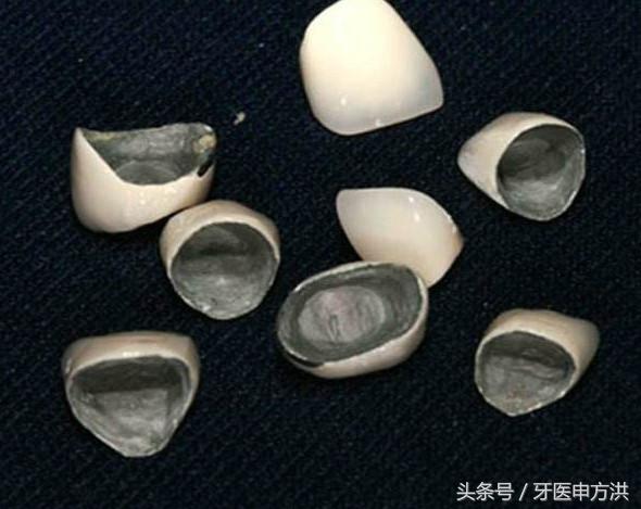 烤瓷牙边缘变黑了怎么修复,烤瓷牙真牙变黑了怎么处理