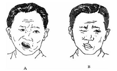 中风面瘫嘴歪了快速治疗方法,面瘫高压氧舱治疗有效吗