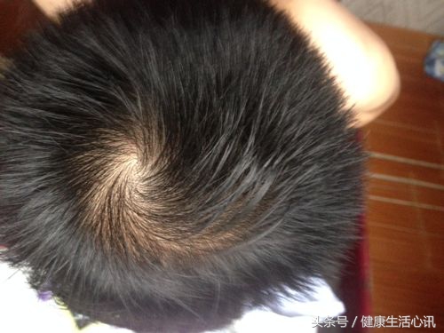 头发出油头皮屑多脱发是什么原因,头发容易油还脱发怎么办