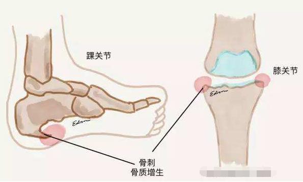 中医治疗骨刺特效方,治老年骨刺有效的膏药