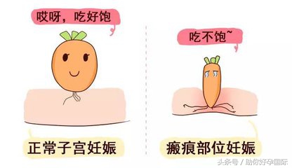 瘢痕子宫怀孕后要关注些什么,瘢痕子宫再怀孕需要关注什么