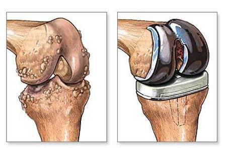 中医治疗骨刺特效方,治老年骨刺有效的膏药