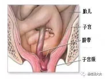 产妇突发脐带脱垂医生跪姿托举,脐带脱垂生死营救视频