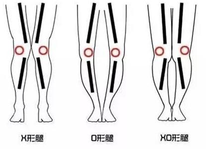 小腿外翻拉伸正确动作,小腿外翻能通过动作矫正吗