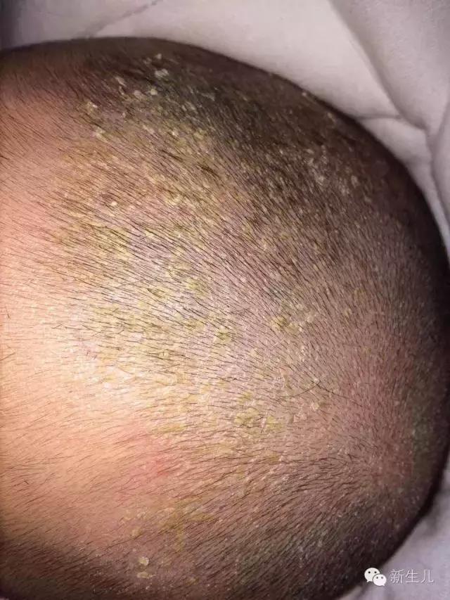 新生儿：婴儿皮肤起红疹？教你如何护理宝宝娇嫩的皮肤