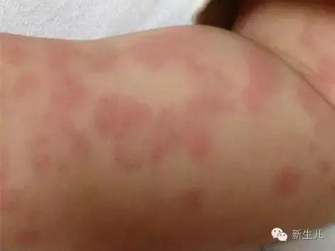 新生儿：婴儿皮肤起红疹？教你如何护理宝宝娇嫩的皮肤