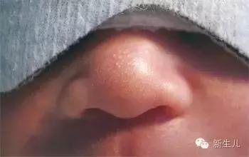 新生儿：婴儿皮肤起红疹？教你如何护理宝宝娇嫩的皮肤