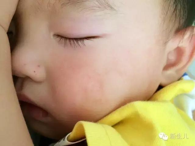新生儿：婴儿皮肤起红疹？教你如何护理宝宝娇嫩的皮肤