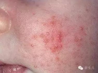新生儿：婴儿皮肤起红疹？教你如何护理宝宝娇嫩的皮肤