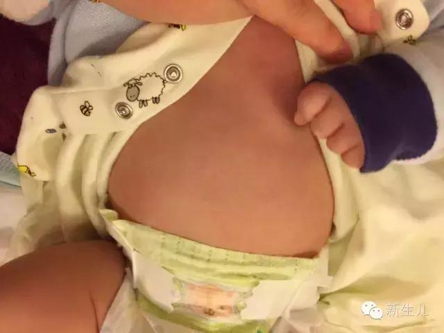 新生儿：婴儿皮肤起红疹？教你如何护理宝宝娇嫩的皮肤