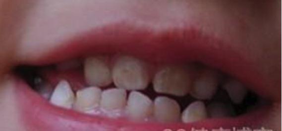 10岁小孩蛀牙怎么处理,10岁牙齿蛀牙烂掉怎么办