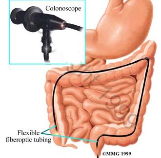 肠道迂曲,肠子是弯曲的肠镜怎么做的