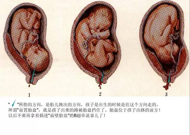 “胎盘低置状态”是个什么状态？