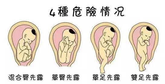 胎儿臀位出生视频,孕晚期胎儿臀位纠正视频