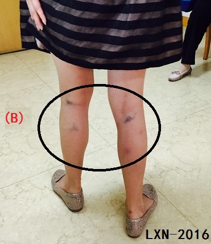 针刺放血疗法能治哪些病,放血疗法治疗腰间盘突出症