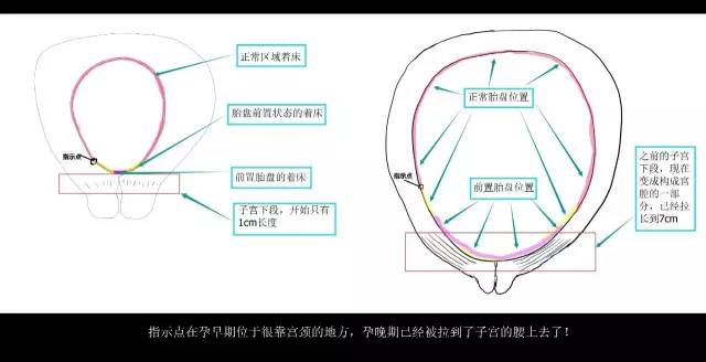 “胎盘低置状态”是个什么状态？