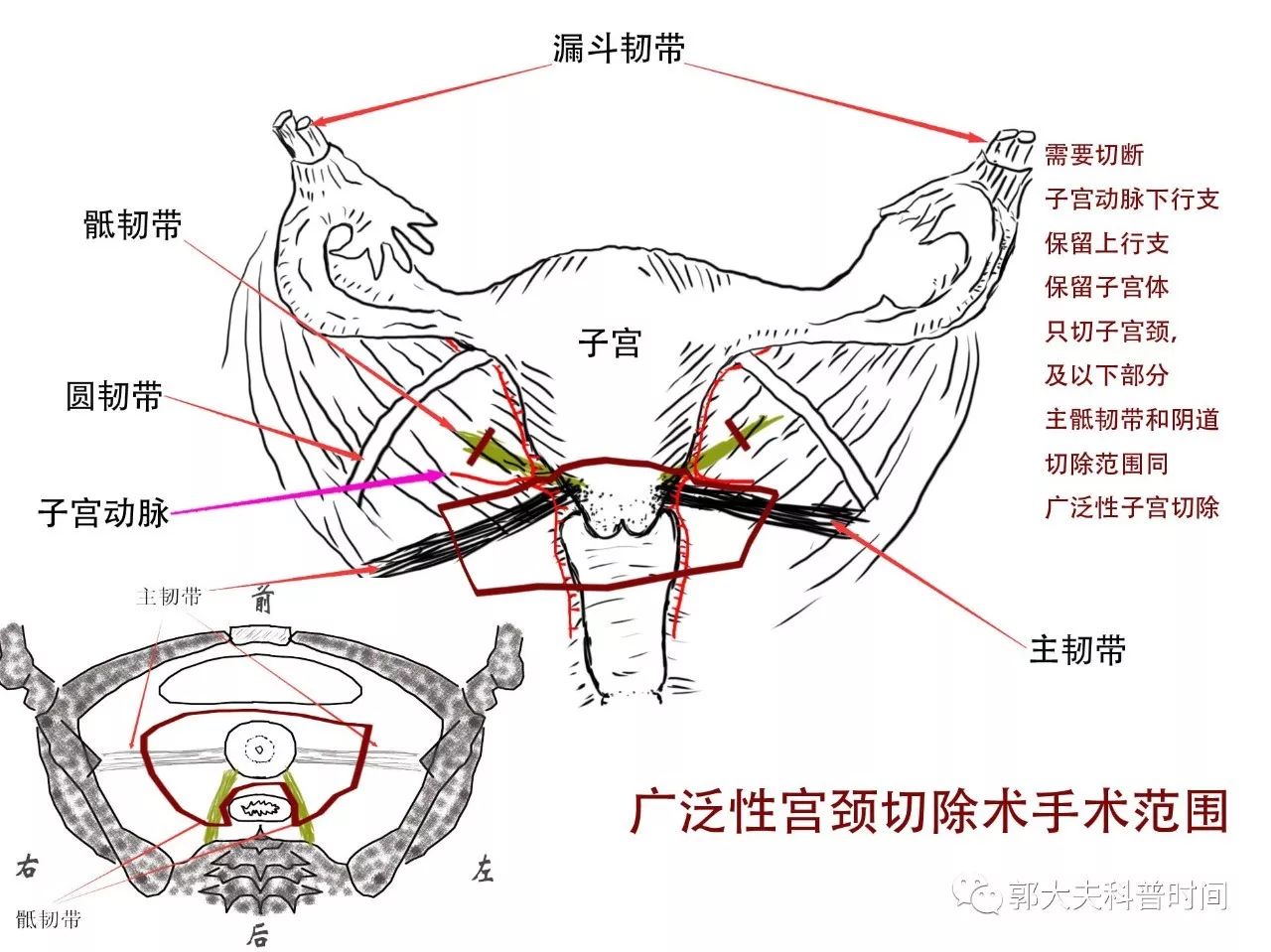 关于子宫切除的小秘密（一）——切除范围