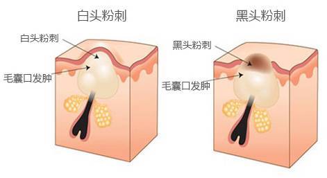 黑头粉刺闭口毛孔粗大面膜,怎么消除黑头粉刺