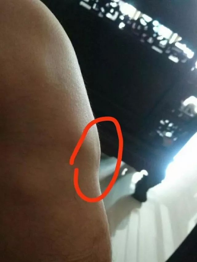 髌腱支持带在哪个位置,髌腱炎和髌腱末端病的区别