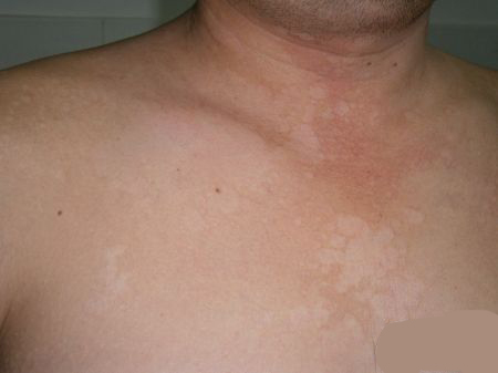 一个不能轻忽的感染，皮肤真菌感染的药物治疗