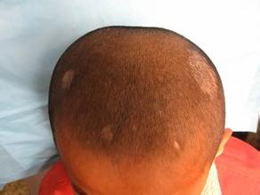 一个不能轻忽的感染，皮肤真菌感染的药物治疗