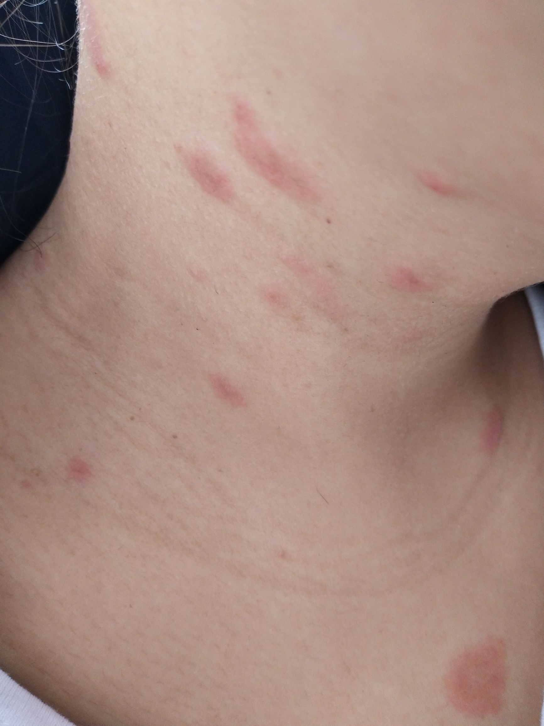 玫瑰糠疹有什么需要关注的,玫瑰糠疹自愈后还需要忌口吗