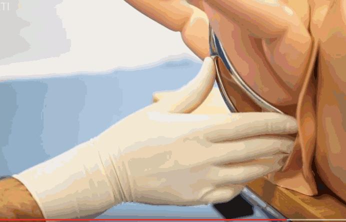 胎儿臀位出生视频,孕晚期胎儿臀位纠正视频